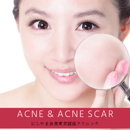 acne  acne scar.jpg